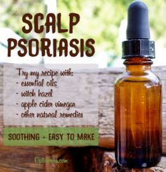 Scalp psoriasis can be very annoying and embarrassing. I find this ...