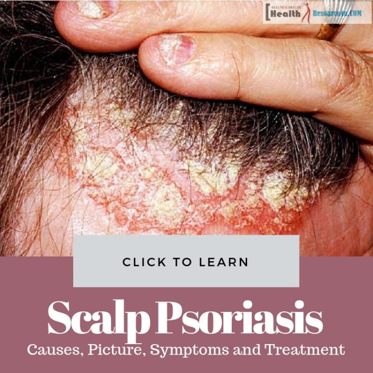 Scalp Psoriasis: Causes, Picture, Symptoms and Treatment