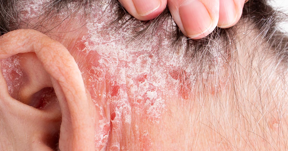 Scalp Psoriasis: Everything You Need to Know About Scalp Psoriasis