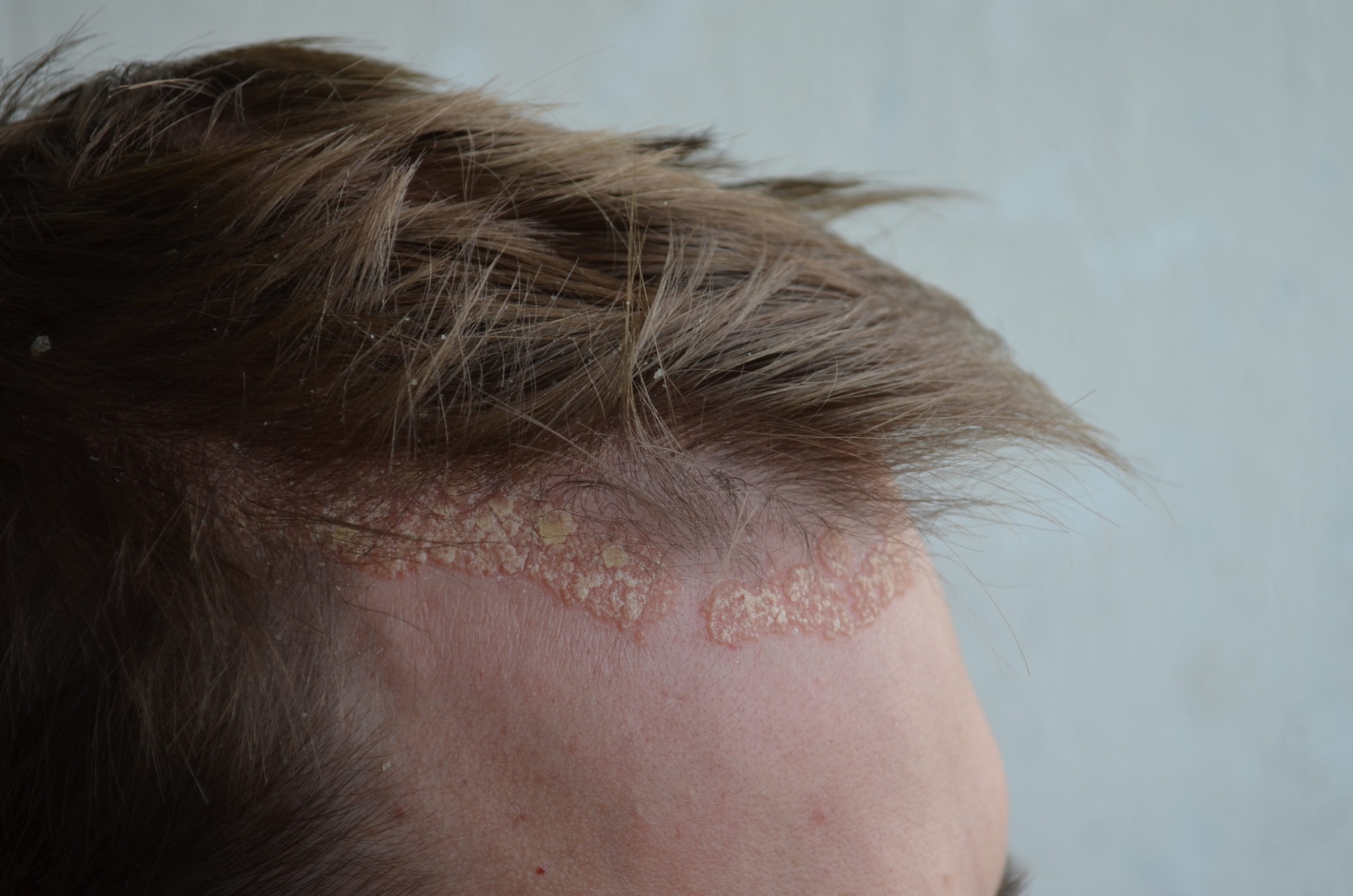 scalp psoriasis forehead hairline