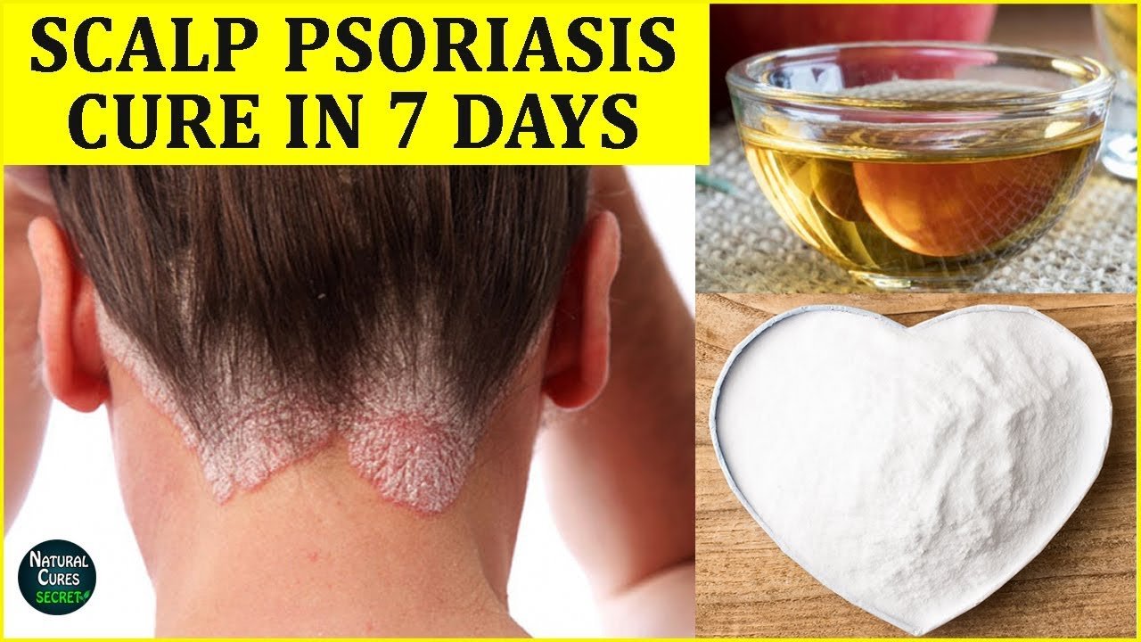 Scalp Psoriasis: How To Cure Scalp Psoriasis Naturally in ...