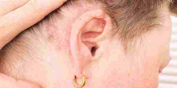 Scalp Psoriasis Occlusion Ears Have