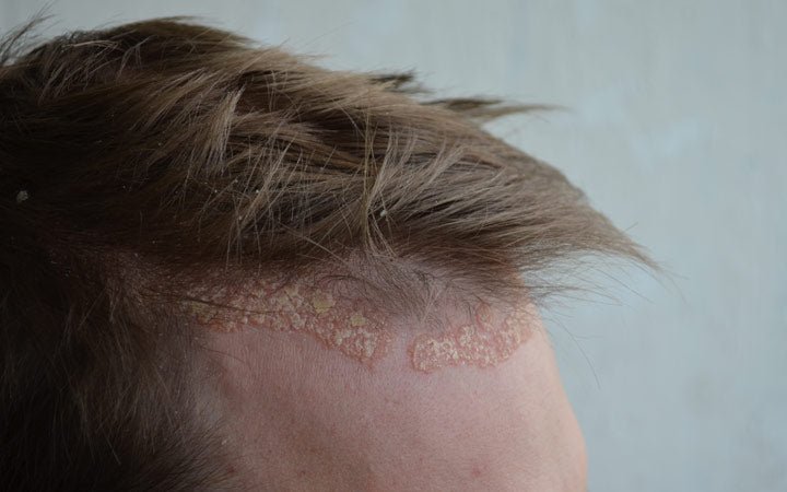 Scalp Psoriasis: Oral &  Topical Treatments, Home Remedies ...