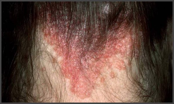 Scalp psoriasis pictures