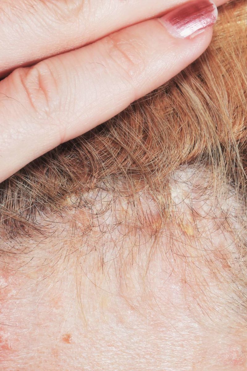 Scalp psoriasis: Shampoos, home remedies, and causes