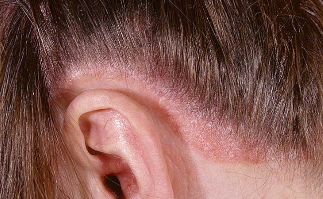 Scalp psoriasis symptoms pictures, mild scalp psoriasis ...