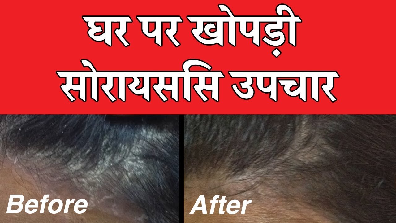 Scalp Psoriasis Treatment At Home In Hindi