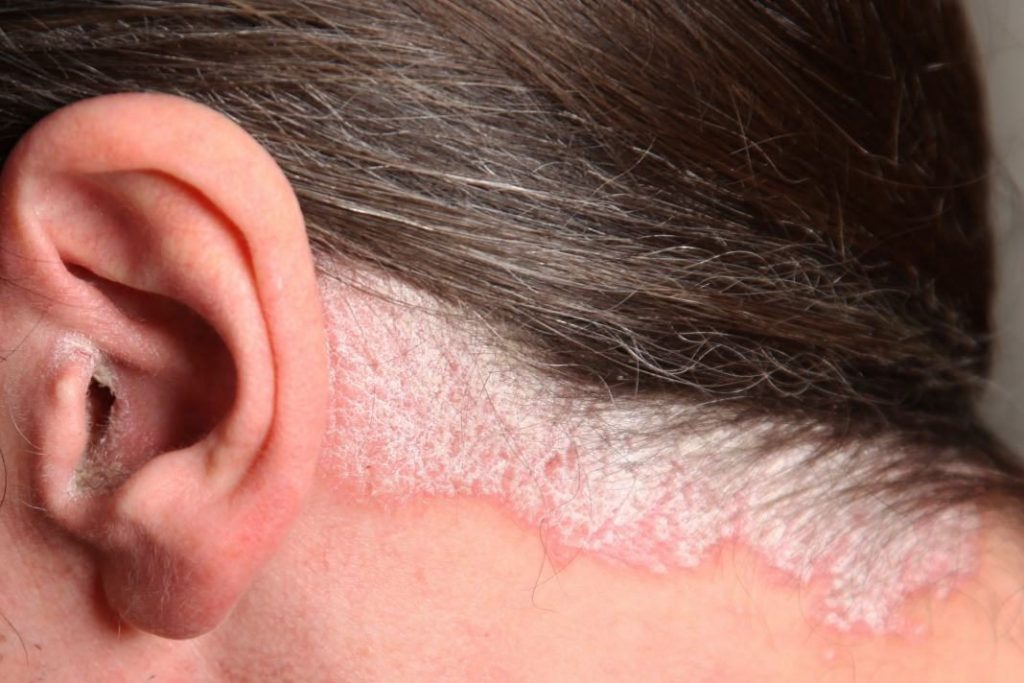 scalp psoriasis Verdura Care