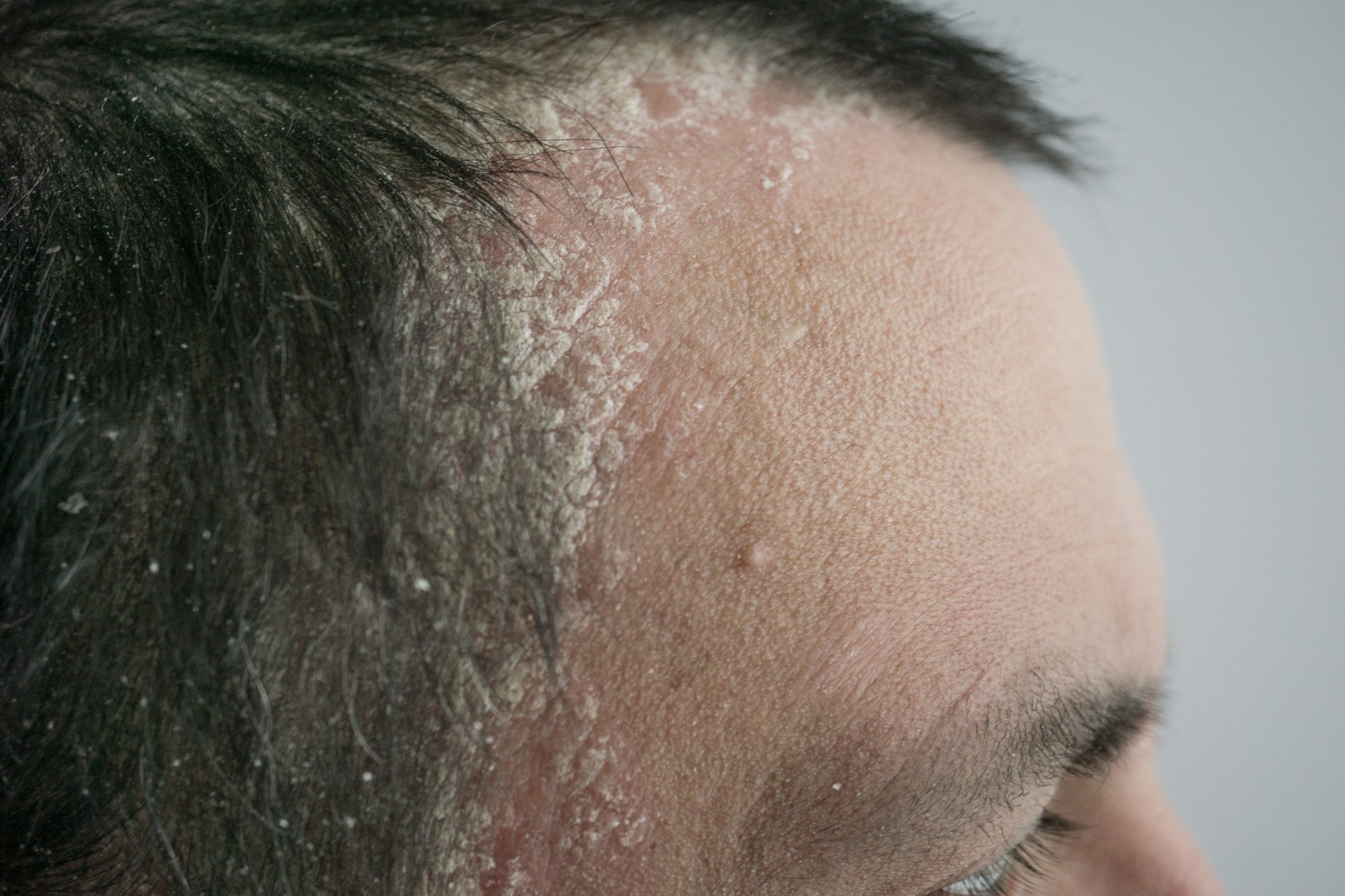 Scalp Psoriasis: What Dermatologists Wish You Knew