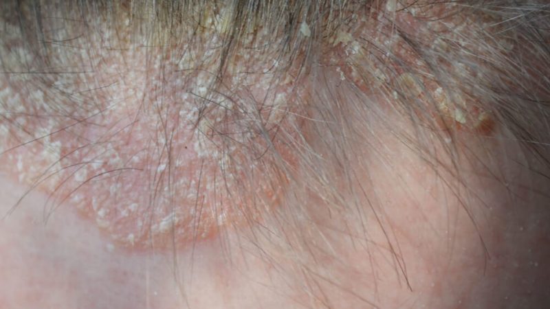 Scalp Psoriasis: What Dermatologists Wish You Knew