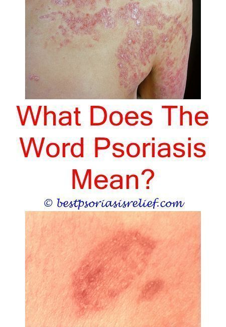 #scalppsoriasispictures what is the best way to get rid of psoriasis ...