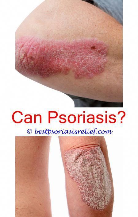 scalppsoriasisshampoo ichthyosis and psoriasis