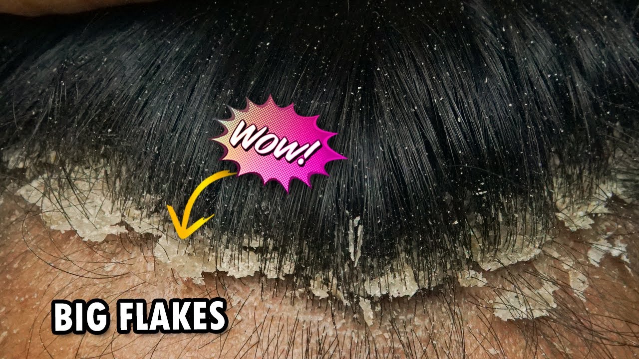 Scratching Scalp Psoriasis Flakes!!! Dandruff Removal ...