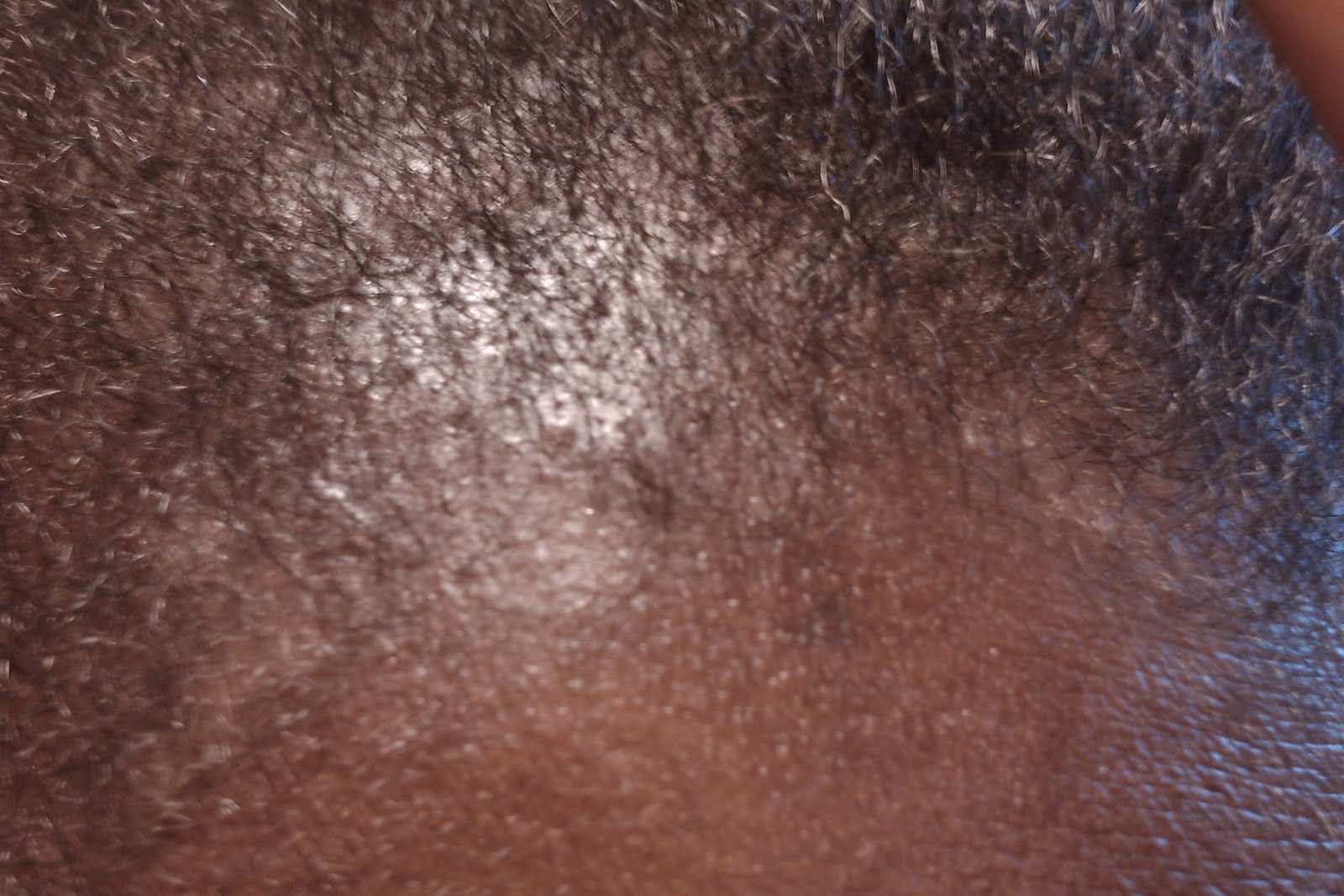 seborrheic dermatitis hairline