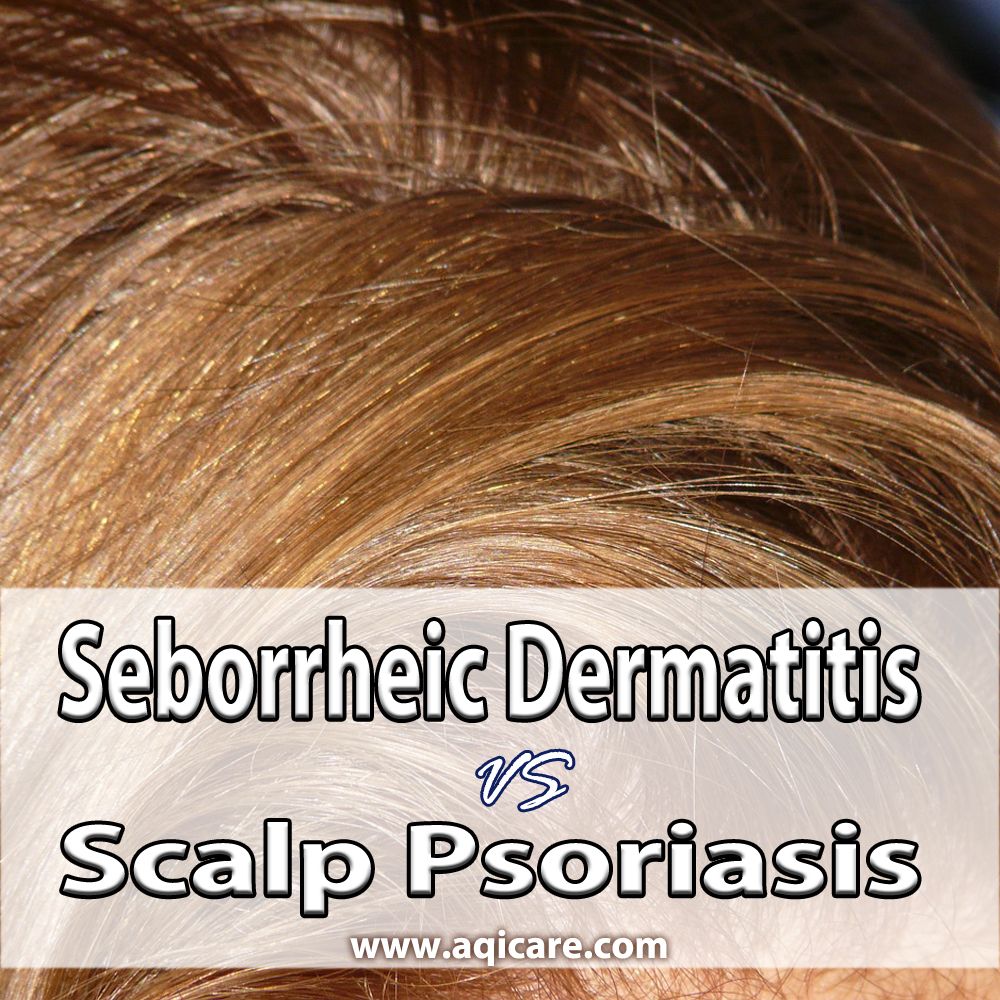 Seborrheic Dermatitis VS Scalp Psoriasis