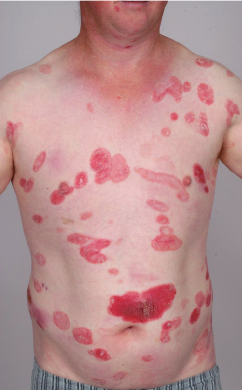 Severe cutaneous psoriasis with characteristic ...
