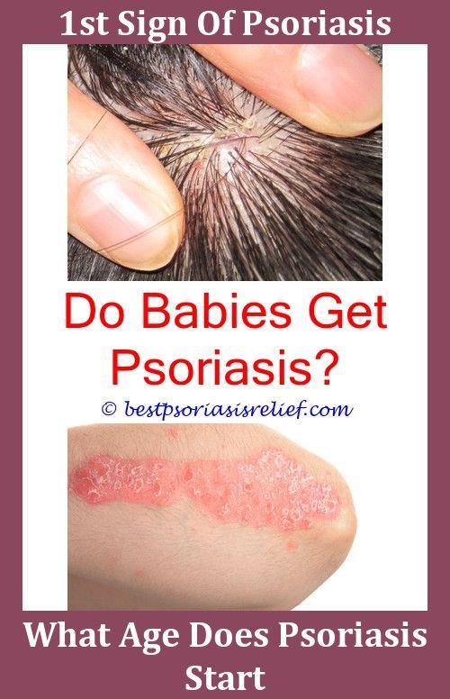 Severepsoriasis Best Lotion For Eczema And Psoriasis ...