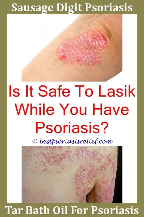 Severepsoriasis Psoriasis Food Allergy,tea for psoriasis ...