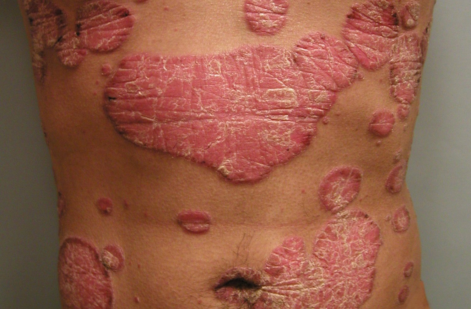 Severity of Psoriasis Linked to Increased Risk of Death ...
