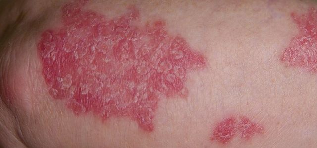 Show Me Pictures Of Psoriasis
