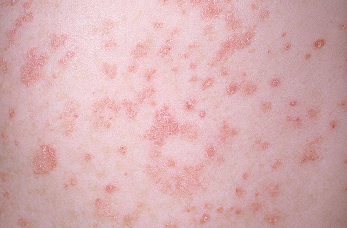 Show me pictures of psoriasis