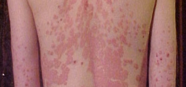 Show Pictures Of Plaque Psoriasis