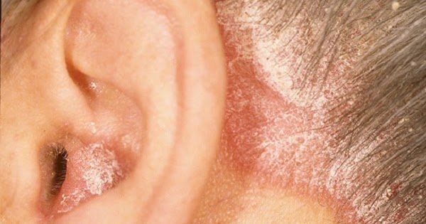 Signs And Symptoms Of Psoriasis In The Ears!
