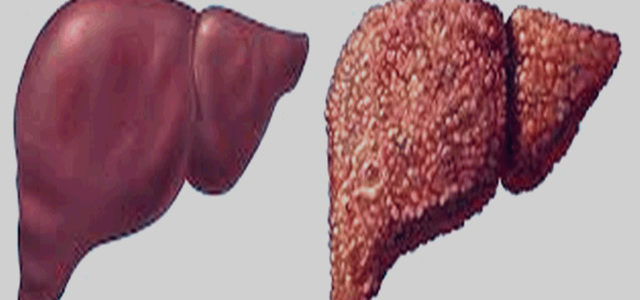Signs And Symptoms Of Psoriasis Of The Liver
