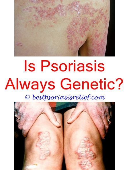 signsofpsoriasis discoid lupus vs psoriasis