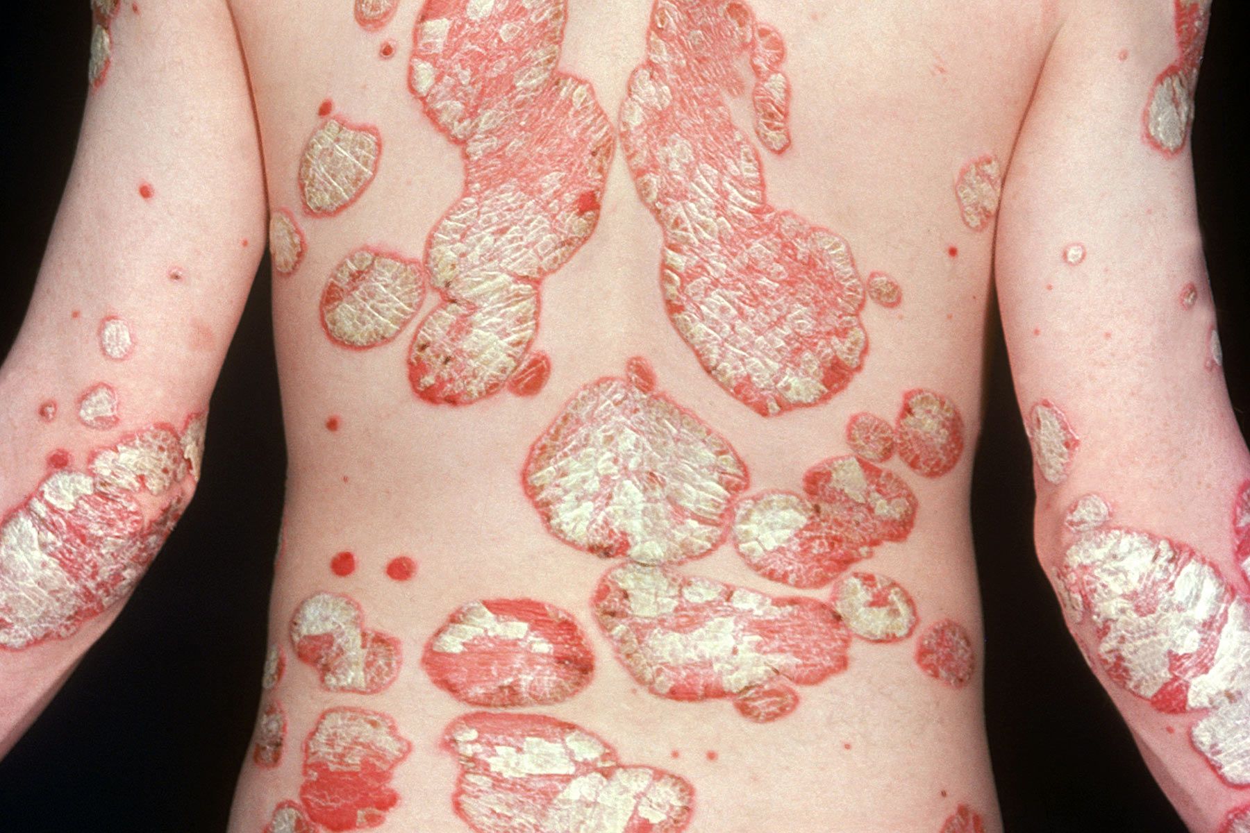 Slideshow: How Severe Is Your Psoriasis?