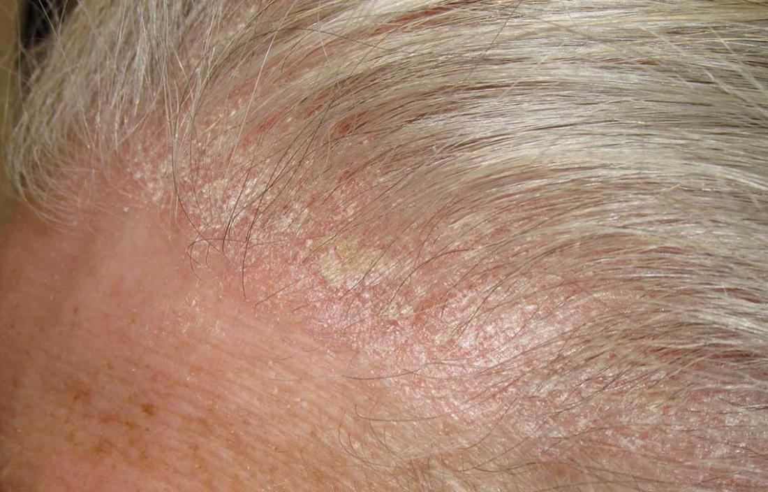 Sores and scabs on scalp: Pictures, causes, and treatment