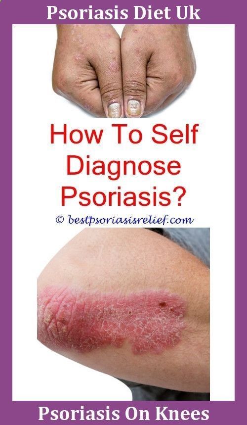 Stop Psoriasis and gain instant relief from the symptoms of Psoriasis ...