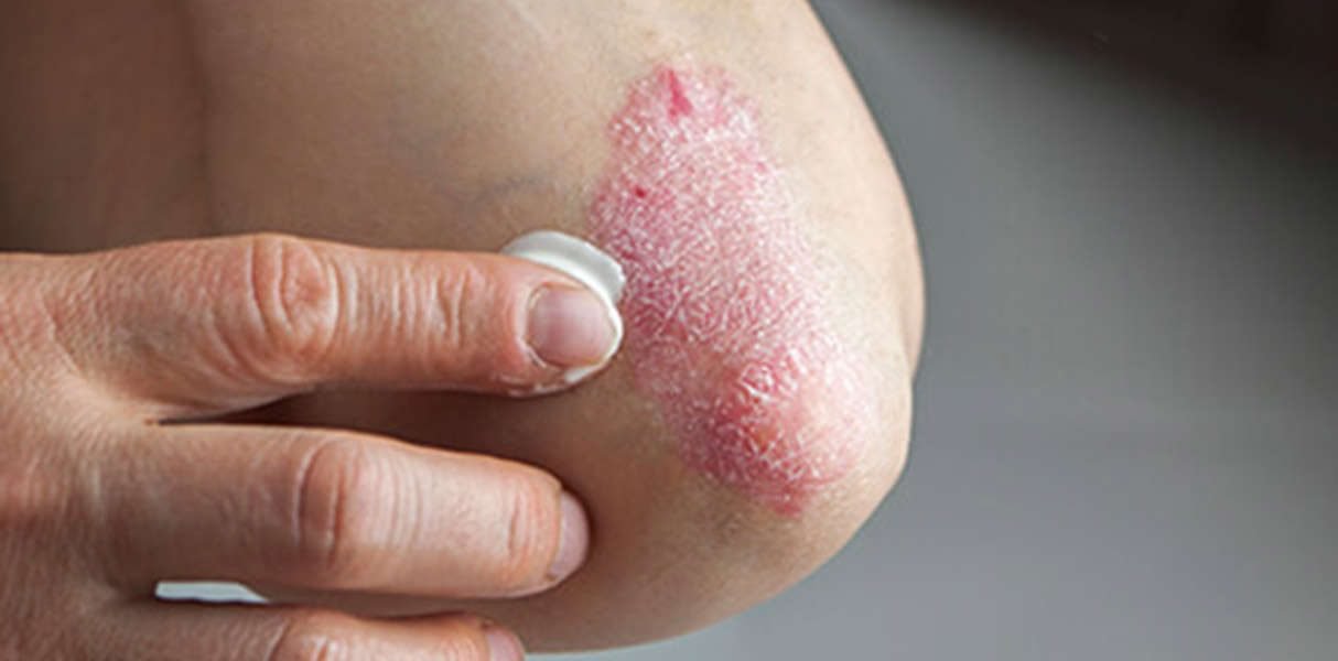 Stop Skin Psoriasis Permanently in 2 Weeks With Revitol ...