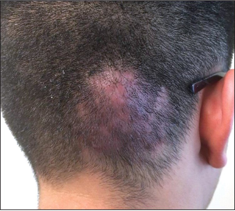 Swelling and Erythema of the Scalp on a Teenager