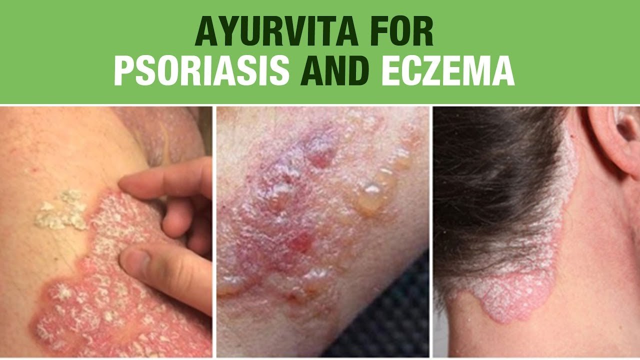 Symptoms of Psoriasis and Eczema