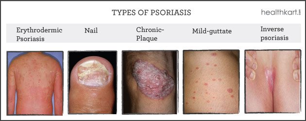 Symptoms of Psoriasis that shouldn
