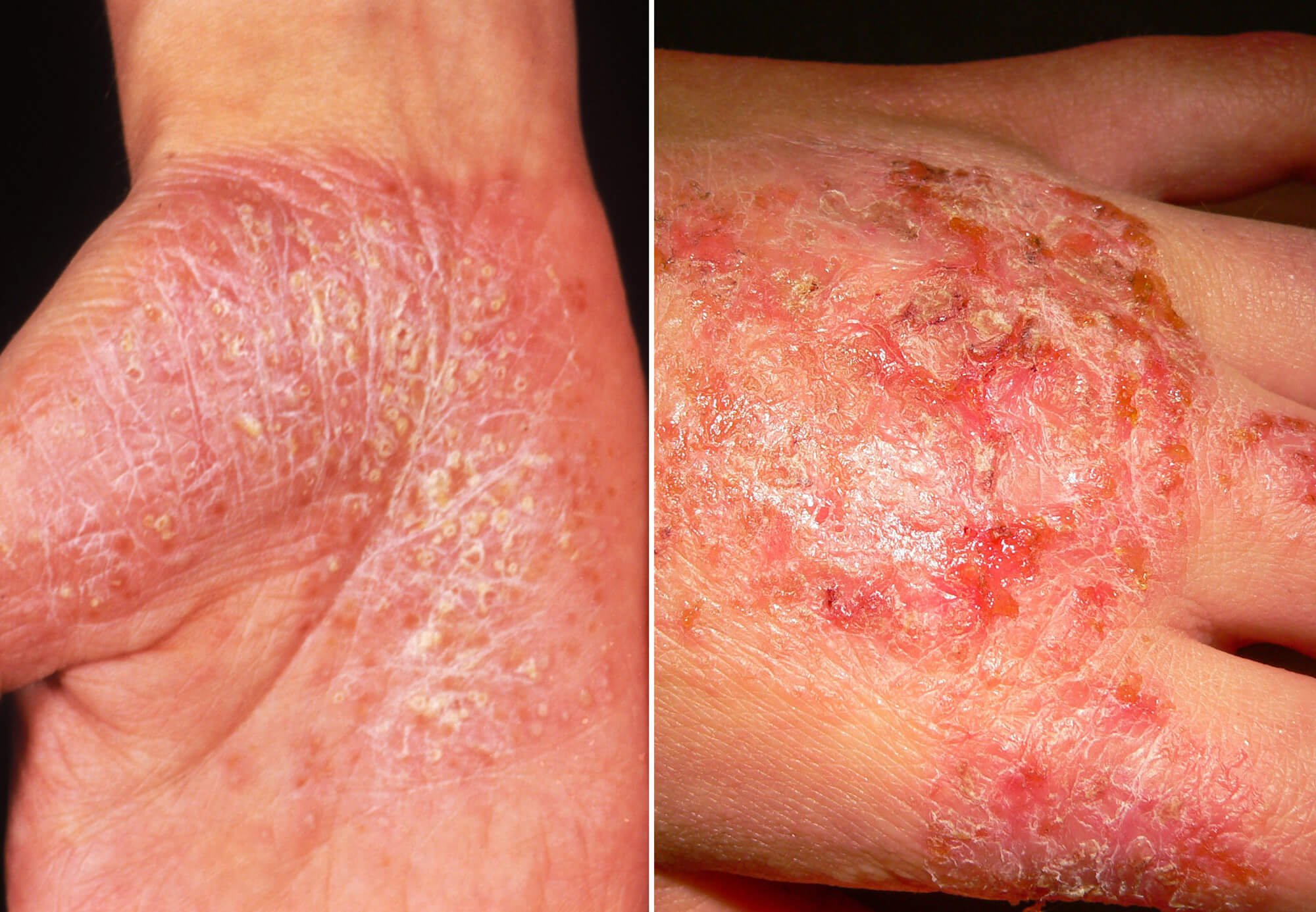 Systematic Review of Eczema in Plaque Psoriasis Treated With Biologic ...