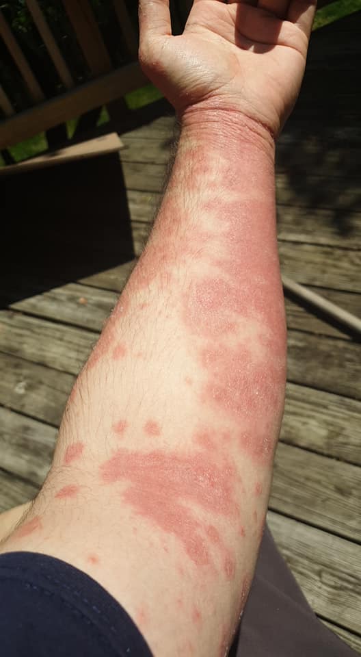 Tanning Psoriasis Results (PHOTOS And Success Stories)