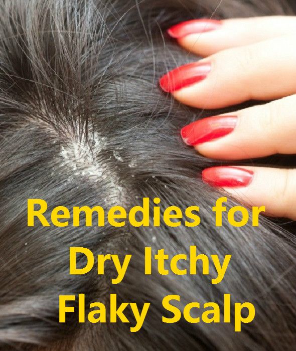 The 25+ best Dry flaky scalp ideas on Pinterest