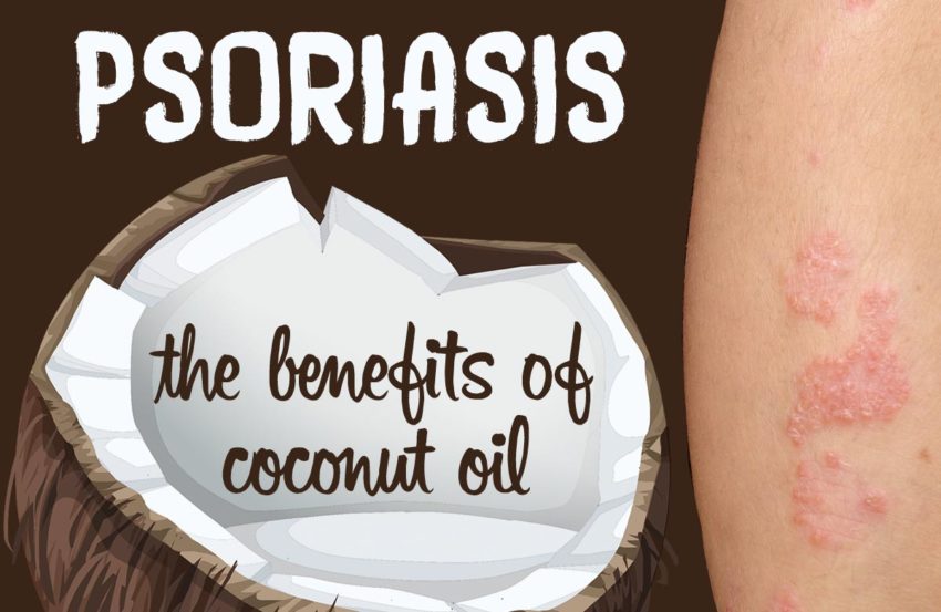 The Benefits of Coconut Oil for Psoriasis