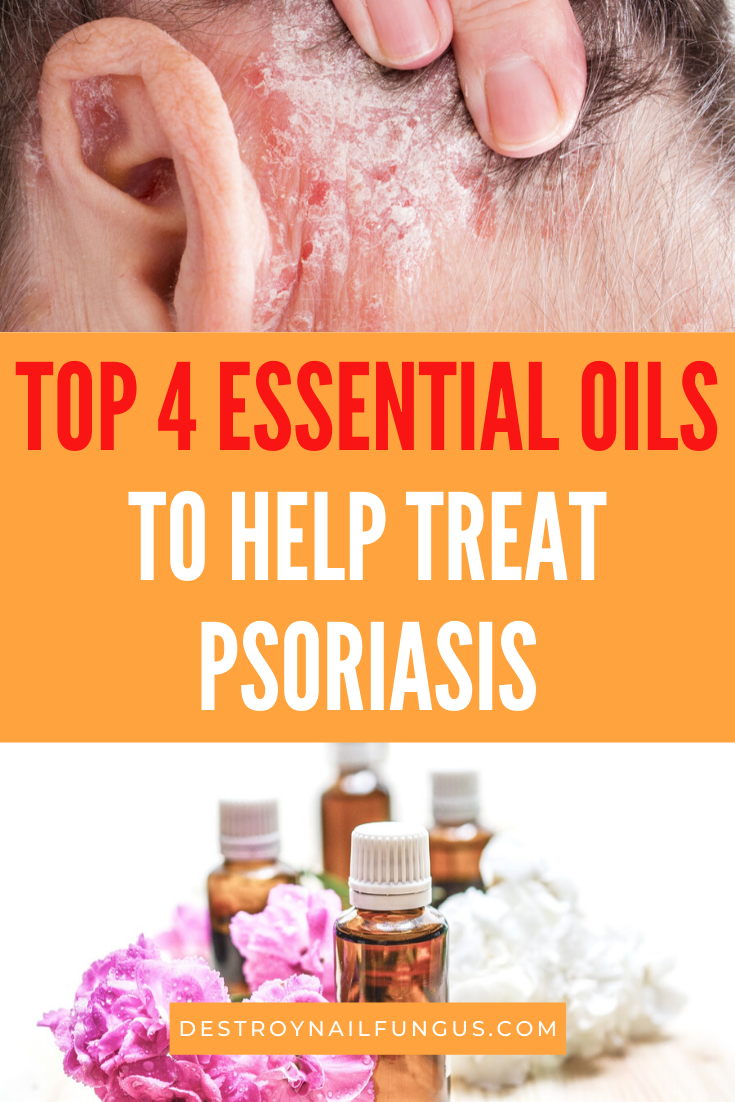 The Best Psoriasis Remedies  Essential Oils For Fast Relief