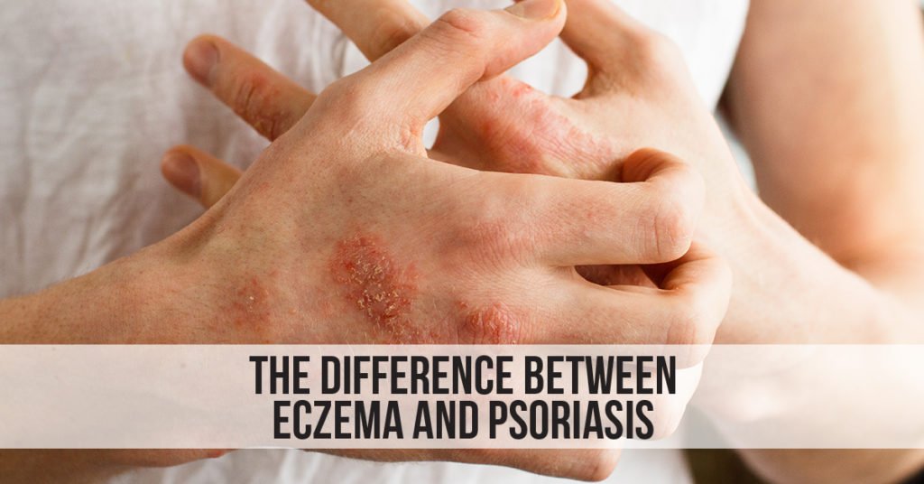 The Difference Between Eczema and Psoriasis