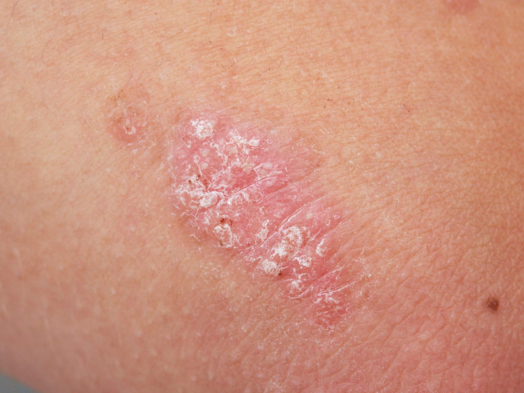 The Difference Between Rosacea, Psoriasis and Eczema