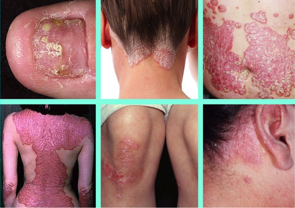 The Different Forms of Scalp Psoriasis And What Dermicoll ...