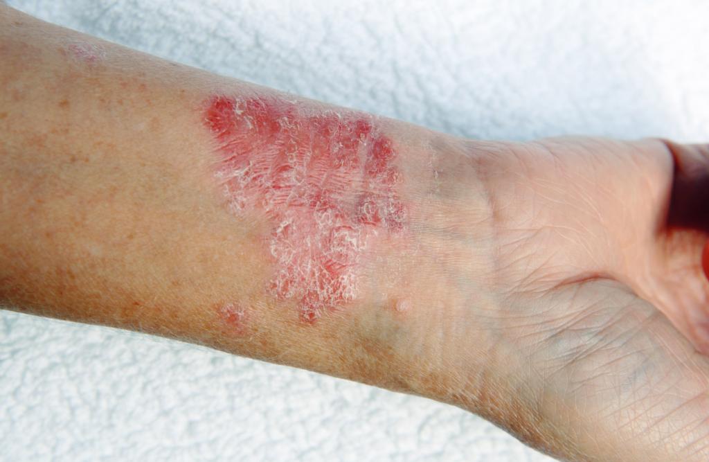 The Early Signs of Plaque Psoriasis