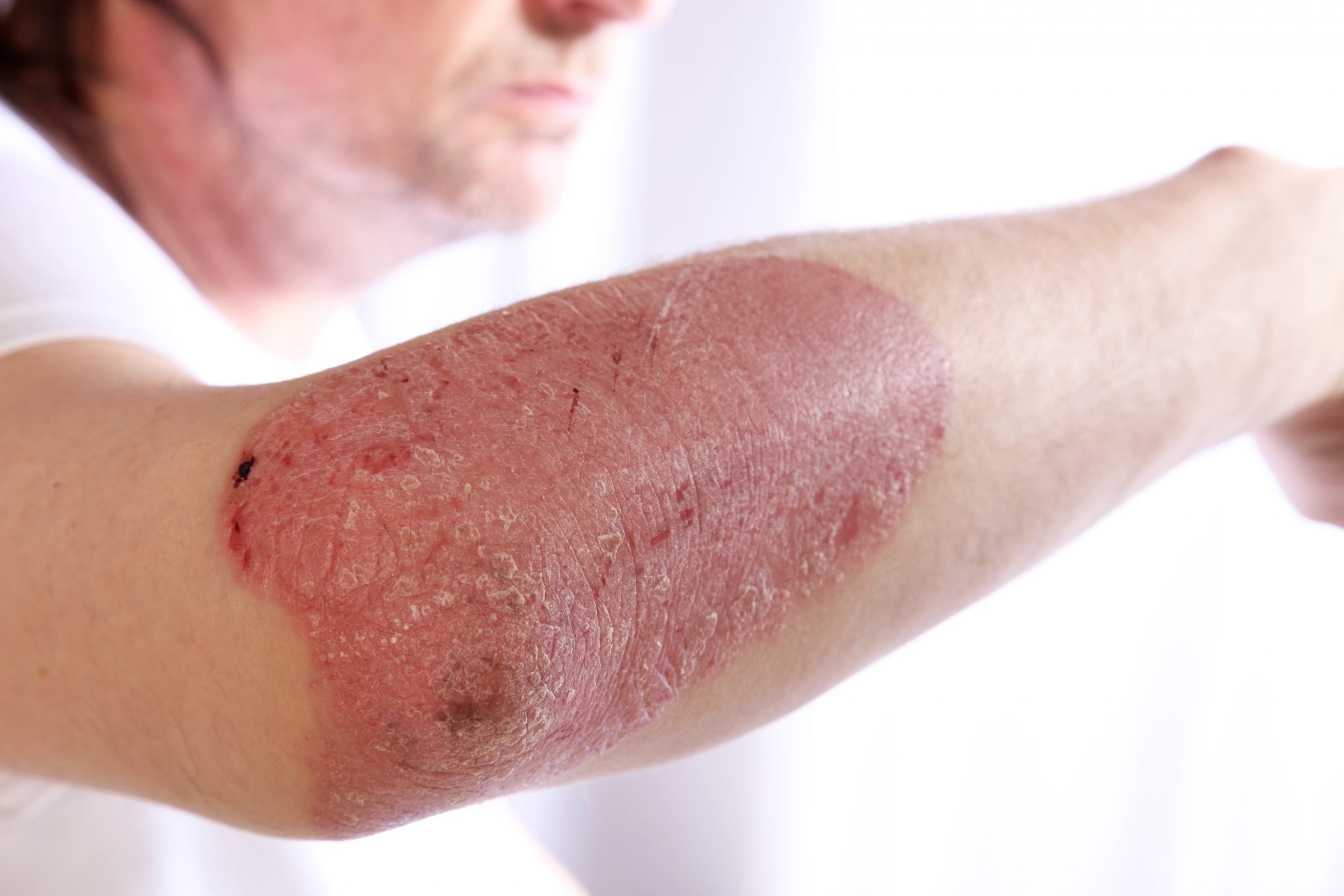 The Heartbreak of Psoriasis Drugs in the age of Covid