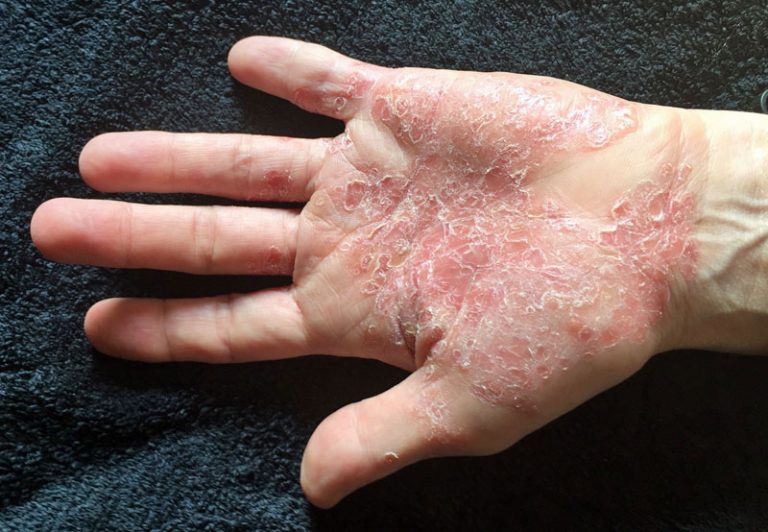 The price of living pain free: The high cost of psoriasis ...