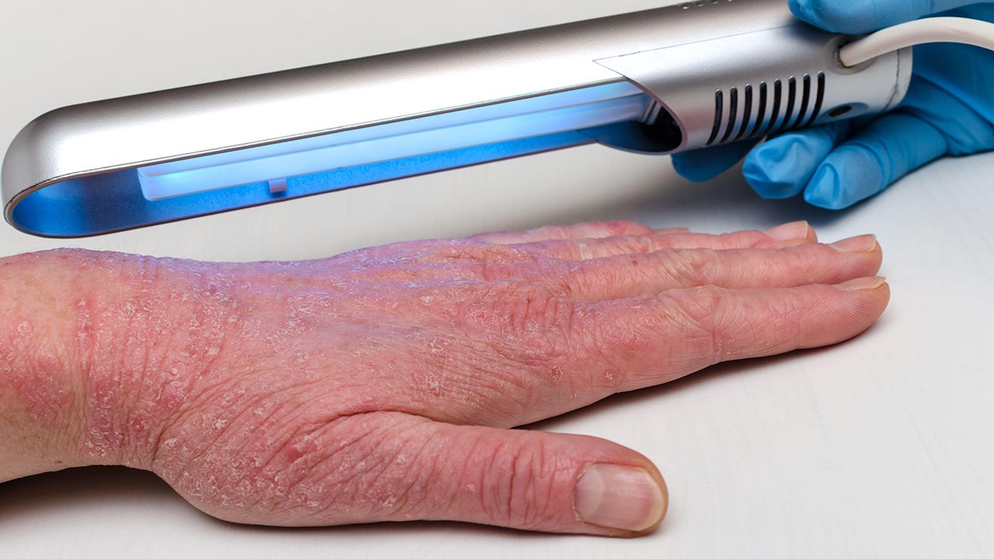 The Pros and Cons of Eczema Light Therapy