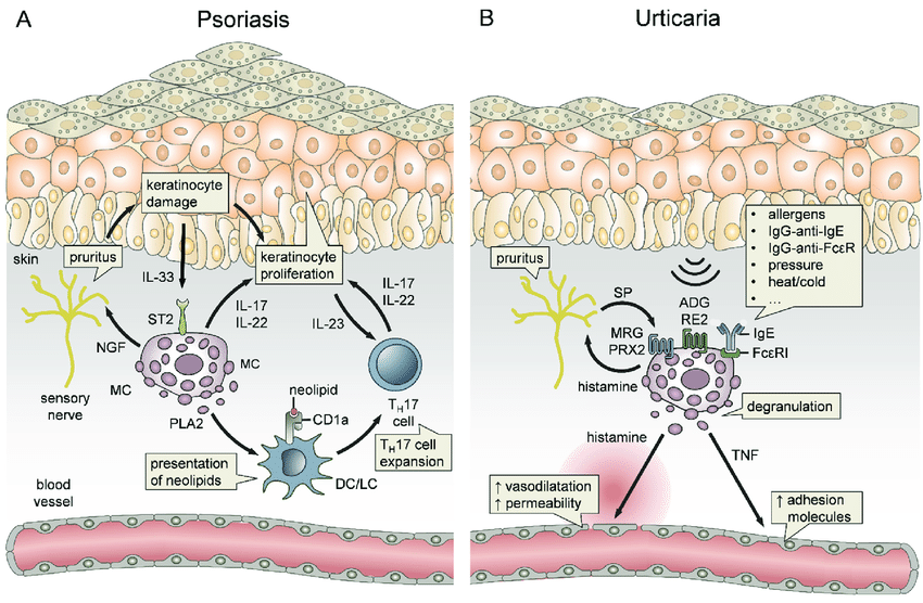 The role of mast cells (MCs) in psoriasis and urticaria ...