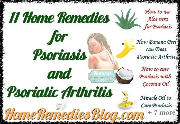 The Top 11 Home Remedies for Psoriasis and Psoriatic ...
